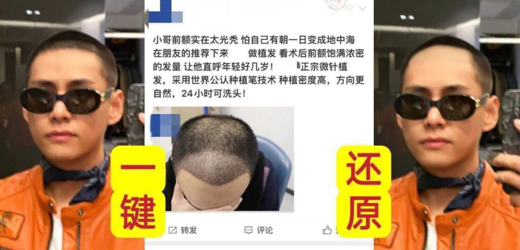 تايهيونغ قام بعملية زراعة الشعر بعد تعرضه الصلع المبكر