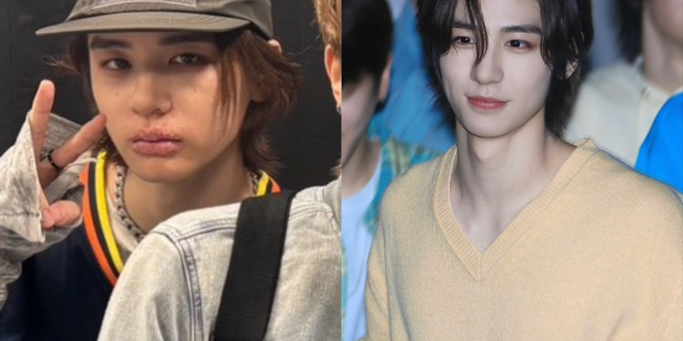 يا إلهي، هذه هي المرة الأولى التي أرى فيها آيدول مصابًا بالهربس : آراء